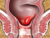 Resep Obat Ambeien Berdarah Paling Ampuh di Apotik Resep Obat Ambeien Berdarah Paling Ampuh di Apotik