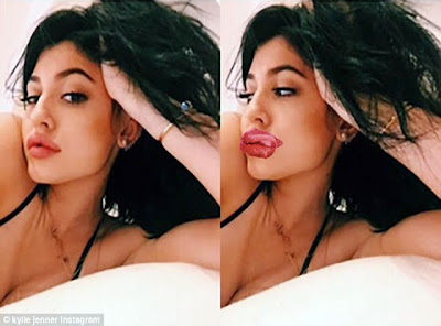 Kylie Jenner lip botox injections puffy lips funny