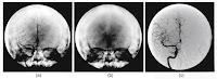 A figure from Intermediate Physics for Medicine and Biology showing a digital subtraction angiography.