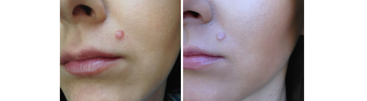 raised facial moles Brown drops from sex