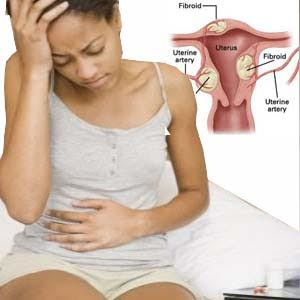 Home remedies for fibroids without surgery exposed!