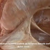 Anatomía de los senos venosos de la dura madre (vídeo)