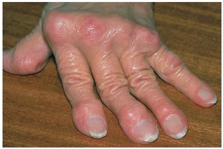 rheumatoid_arthritis_advanced+stage+inflammation+redness+swelling+hot+warm+red+pain+rom+blood+range+of+motion+sedentary+lesions+spread+symptoms+effects+risk+care+prevention+treatment.jpg