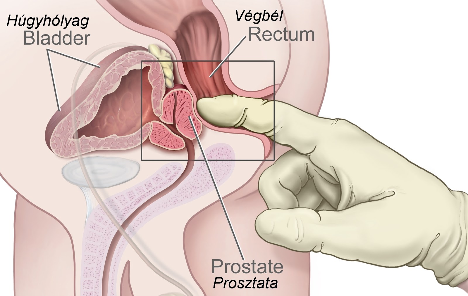 prosztata karcinóma prostatitis dnipro