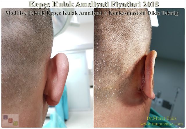 Before and After Photos for Ear Plastic Surgery in Istanbul, Turkey - Ear Plastic Surgery - Protruding Ear Surgery - Modified Technique - Conchomastoid Technique