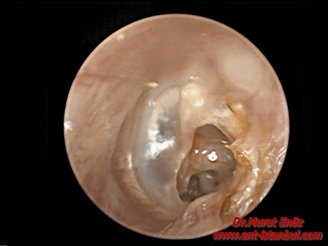 Retraction pocket at the posterior quadrent of eardrum