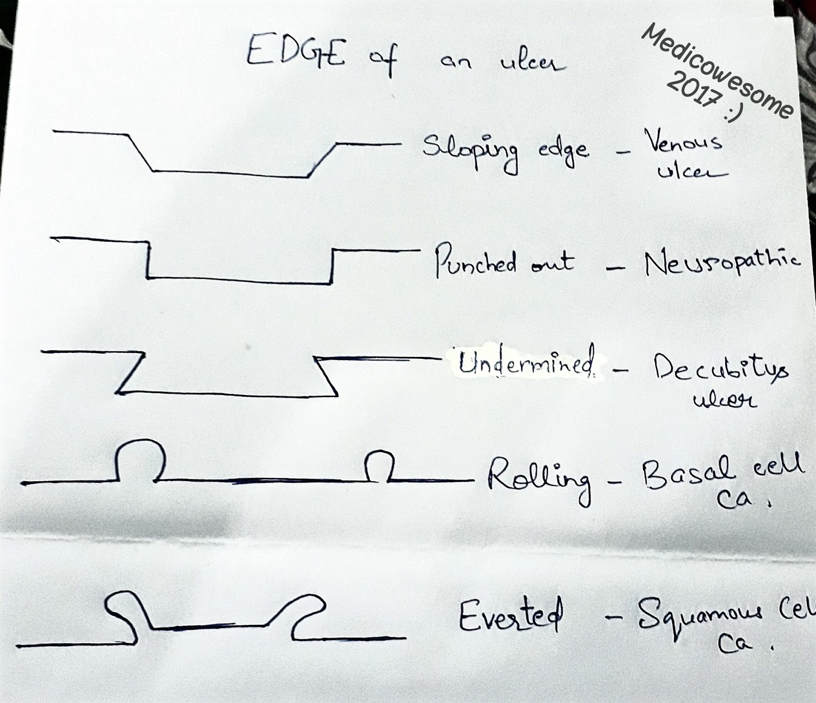 Medicowesome Edge Of An Ulcer An Overview stages-of-decubitus