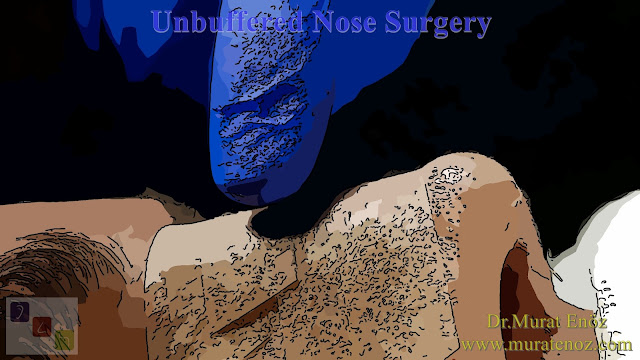 Unbuffered septoplasty surgery - Unbuffered nasal septum deviation surgery - Unbuffered septum deviation operation - Unbuffered nose surgery - Unbuffered SMR operation - Unbuffered septum deviation correction surgery - ENTact Septal Stapler