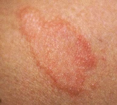 Types Of Skin Rashes From Hepatitis - The Body