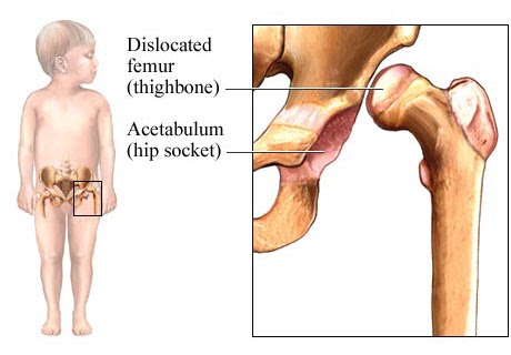 csípő dysplasia kezelése csecsemőnél