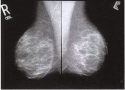 breast images