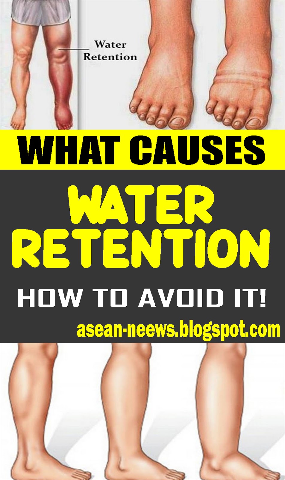What Causes Water Retention And How To Avoid It Care Natural Health
