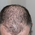 Hair transplant risks and side effects