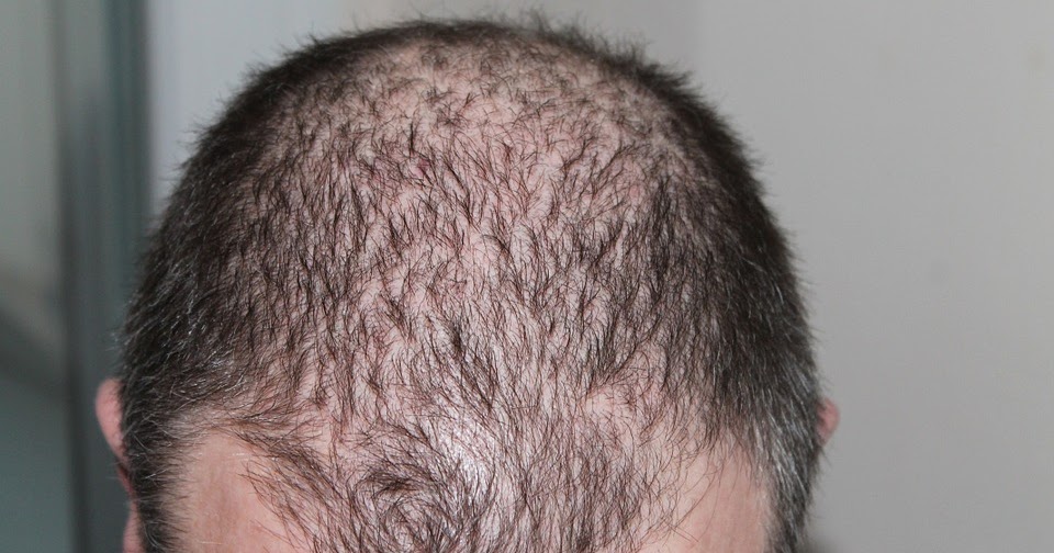 Hair transplant risks and side effects HAFR