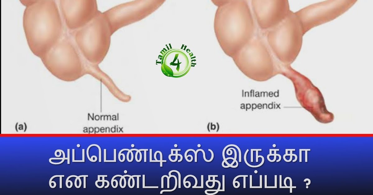 appendicitis symptoms in tamil TAMIL HEALTH