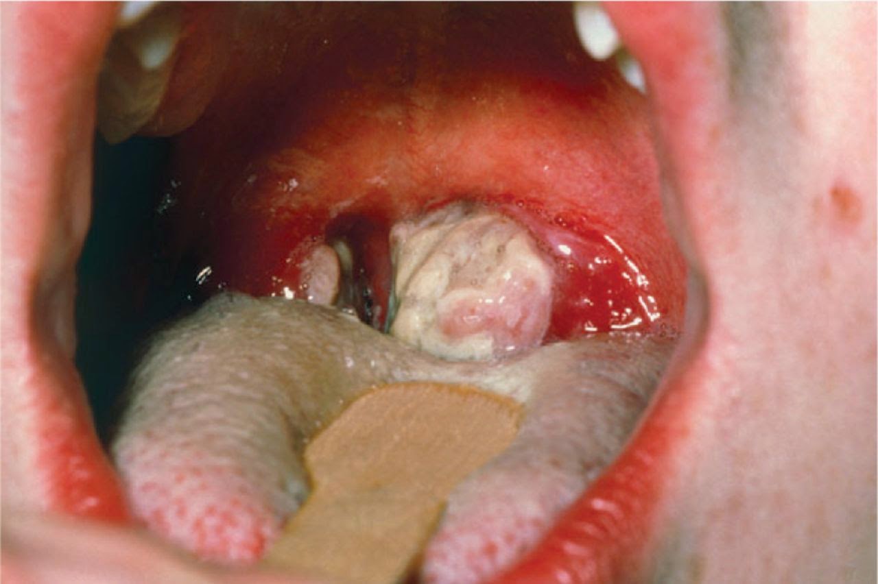 Canker Sore: Overview, Causes, Diagnosis & Pictures