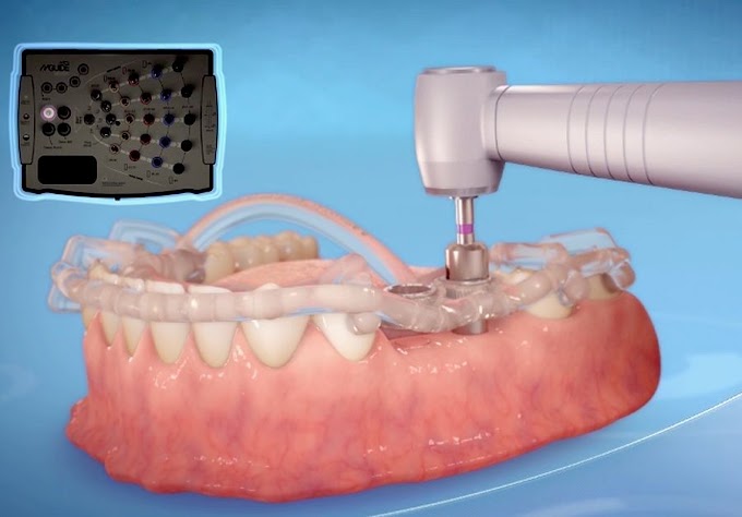 IMPLANTOLOGY: MGuide step by step process