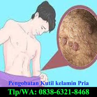 Obat Kutil Kelamin