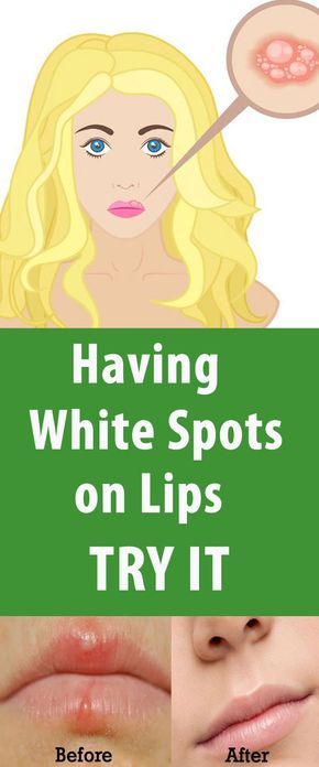 Home Remedies To Get Rid Of White Bumps On Lips Beauty4everything