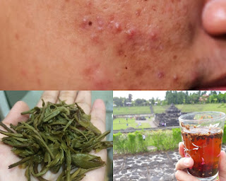 Cara Menghilangkan Jerawat Dengan Teh, Ini Review Yg Mencoba !  Manfaat daun teh ternyata tidak hanya digunakan sebagai bahan untuk dibuat minuman yang m Cara Menghilangkan Jerawat Dengan Teh, Ini Review Yg Mencoba !
