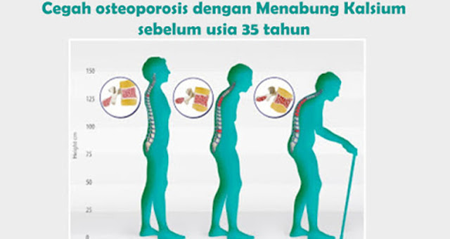 Cegah osteoporosis dengan Menabung Kalsium sebelum usia 35 tahun