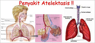 atelektasis-www.healthnote25.com