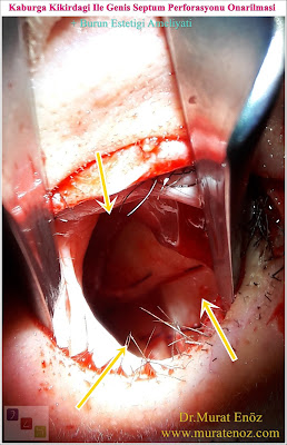 About nasal septum perforation - Symptoms of nasal septum perforation - Diagnosis of nasal septum perforation - Classification of septum perforations - Causes of nasal septum perforation - Nasal septum perforation treatment - Large septum perforation repair with rib cartilage - Large septum perforation repair with rib cartilage - Nasal septal perforation repair with irradiated cadaver rib cartilage - Repair of nasal septal perforation with rib cartilage - Nasal septum perforation repair with irradiated costal cartilage - Septal perforation - Surgical treatment of nasal septal perforation - Septal perforation repair surgery in Istanbul - Perforated septum treatment in Turkey