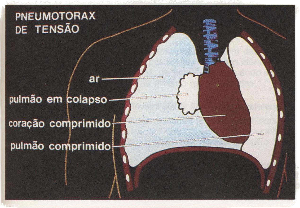 clube de montanhismo de braga Socorro em montanha 13ª parte