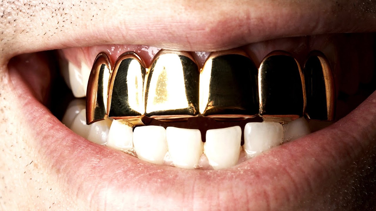 Gold Teeth In Baton Rouge Gold Choices