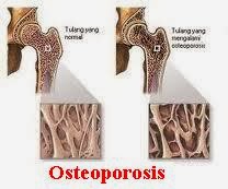 Obat Osteoporosis