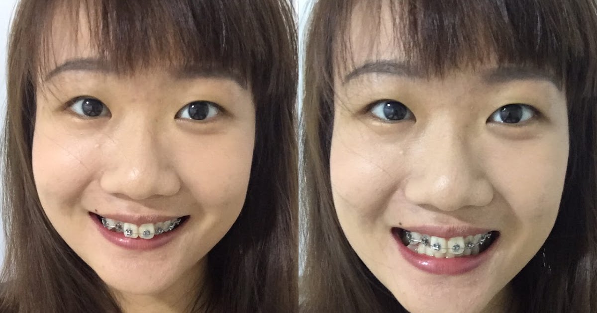 Amanda A. My Braces Journey (Putting on Braces!)