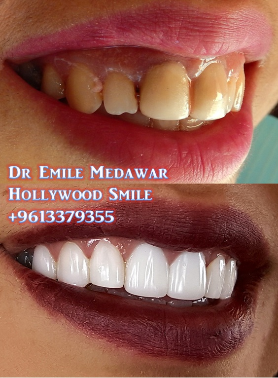 Dr Emile Medawar Smile veneers dubai