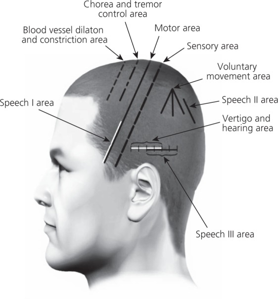 Pemulihan Stroke Semakin Mantap