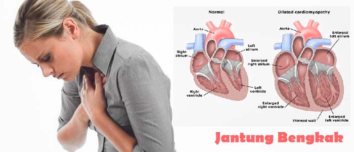 Penyebab, Gejala dan Komplikasi Penyakit Jantung Bengkak