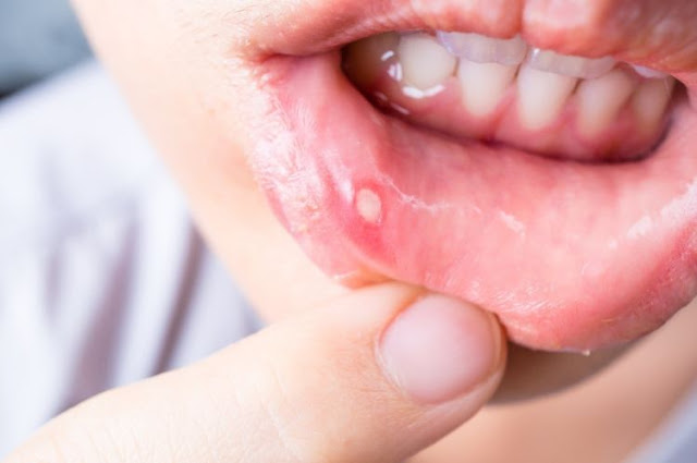 Cara Menyembuhkan Sariawan Dengan Cepat Tanpa Sakit Dan Obat Perih Cara Menyembuhkan Sariawan Dengan Cepat Tanpa Sakit Dan Obat Perih