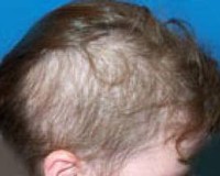 Cocuklarda Sac Dokulmesi Neden Olur