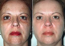 peel jessner before peels insider spa thinking