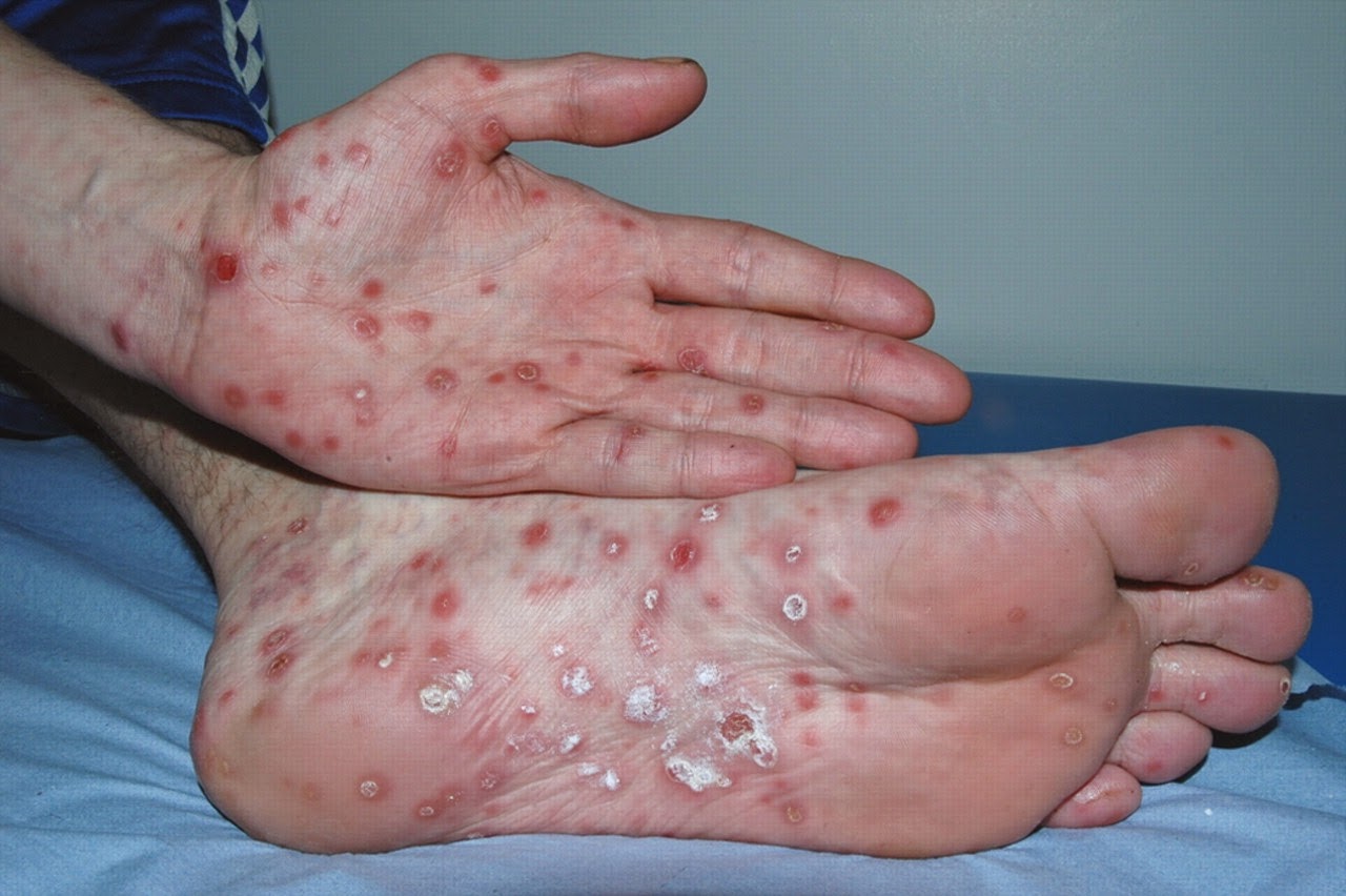 rash on infants #11