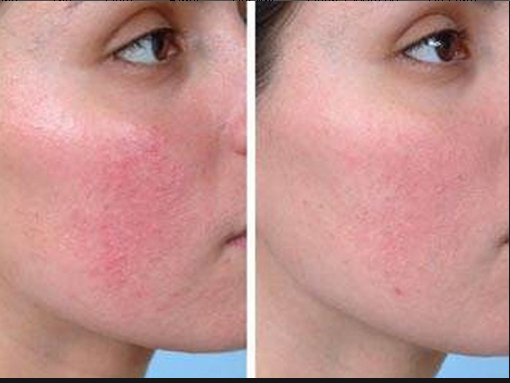 Love Joy: Грижа за кожата с крехки капиляри - купероз, розацея