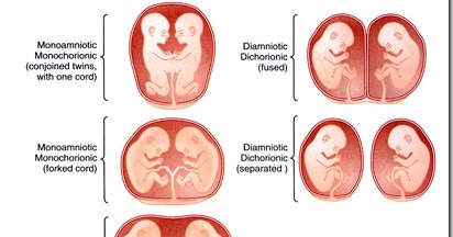 Contoh Kehamilan Gemelli