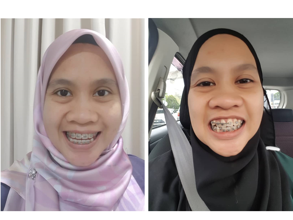 Nanyfadhly Braces Story Updated Part 6
