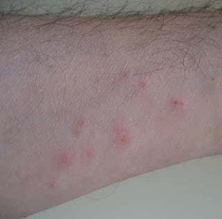 Come Liberarsi Dalle Cimici Da Letto