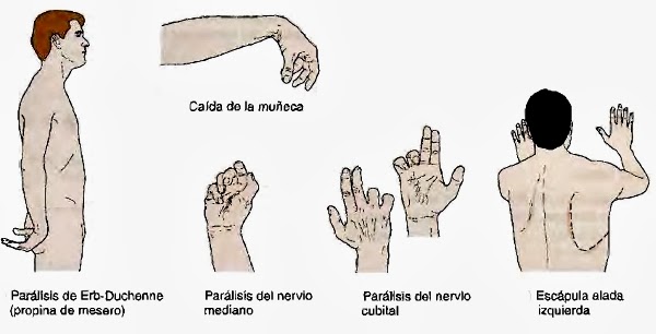 mano linear unit migaja abrasion nerviación radial