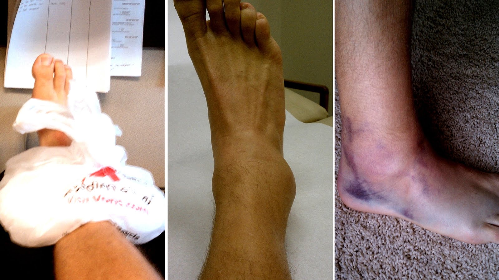 Soccer Ankle Injuries Injury Injury Choices