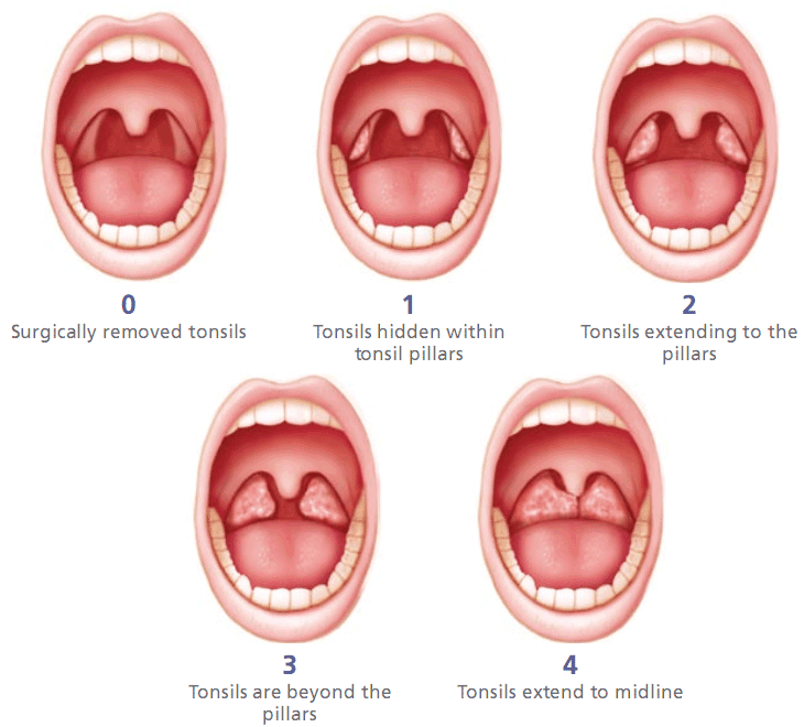 Wednesday Life [EN] Tonsillitis removed
