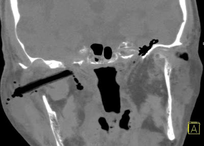 Idegentest a fossa pterygo-palatinában