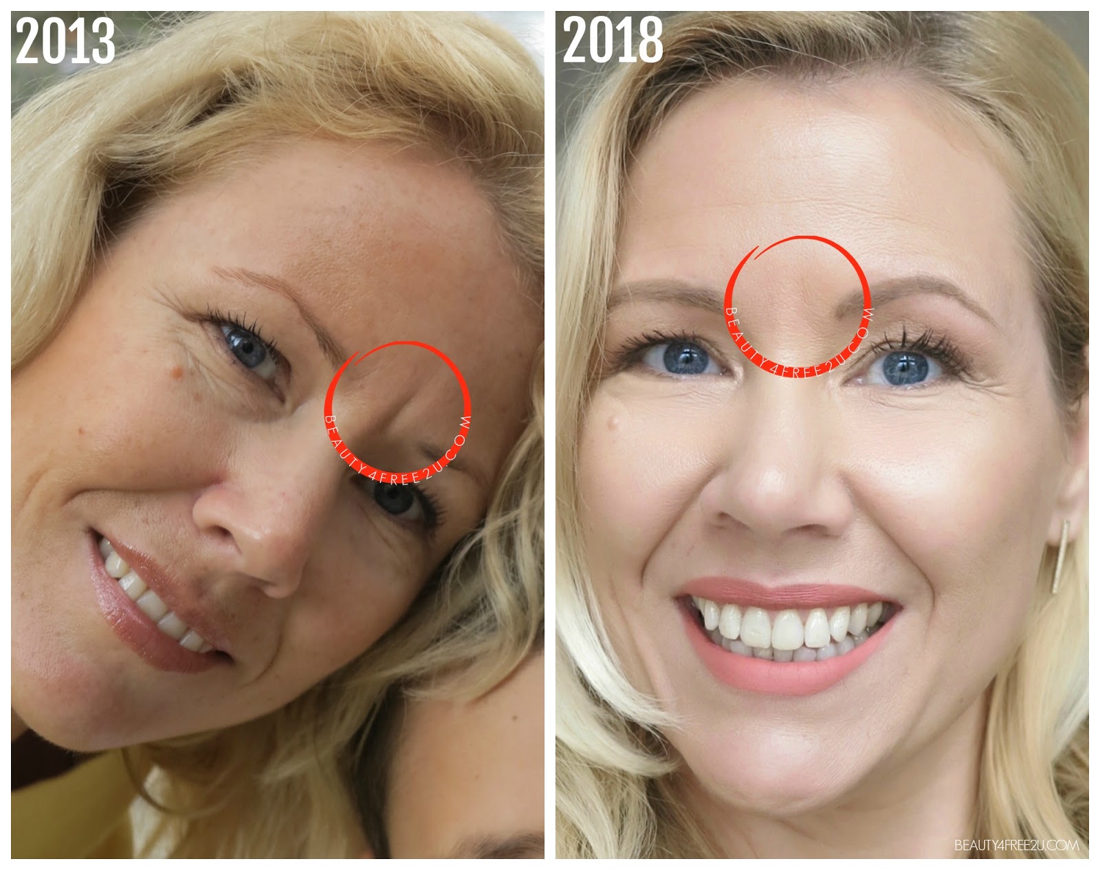 Frownies Before & After Results