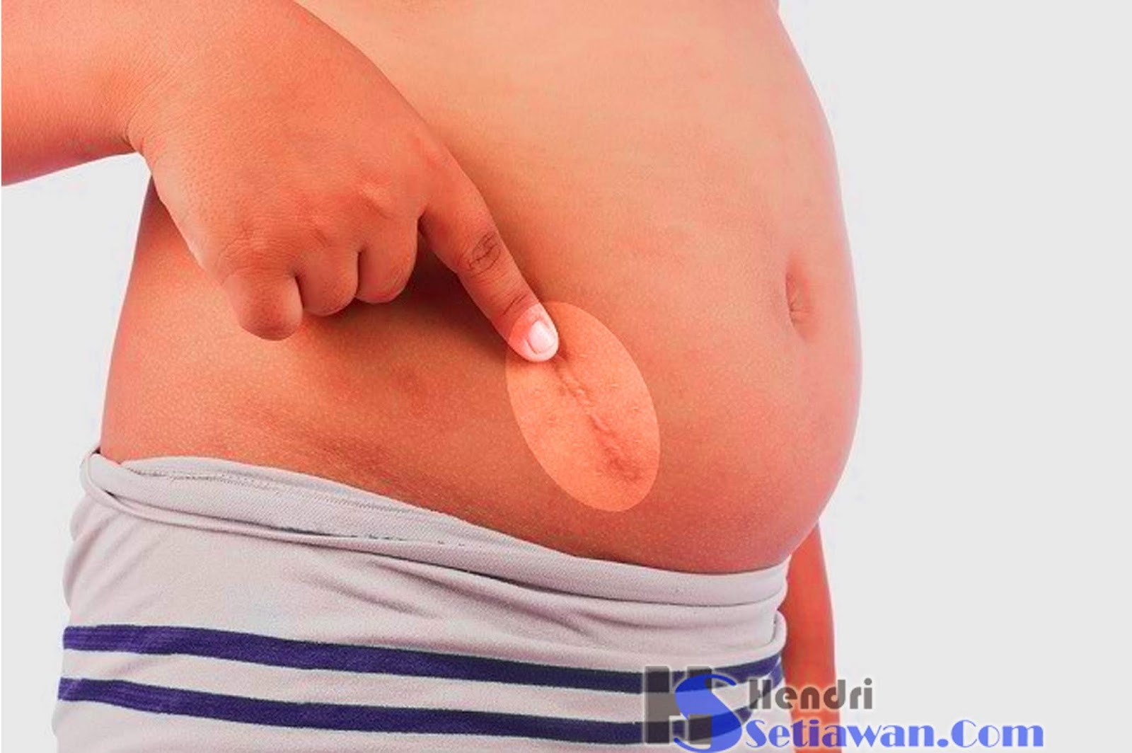 Pengalaman Operasi Usus Buntu Apendiks Hendri Setiawan