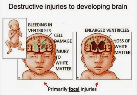 Destructive Injuries To The Developing Brain