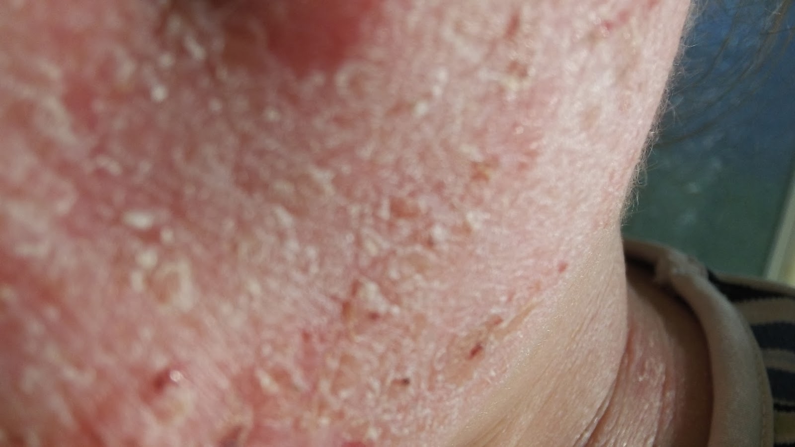 Why Seborrheic Dermatitis Causes Red Flaky Skin - Verywell